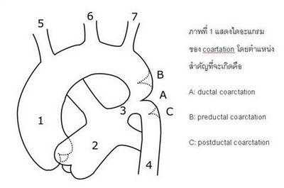 Coarctation of Aorta - มันคืออะไรและทำอะไรกับฉันได้บ้าง?