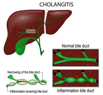 Scleroguing Cholangeitis หลัก